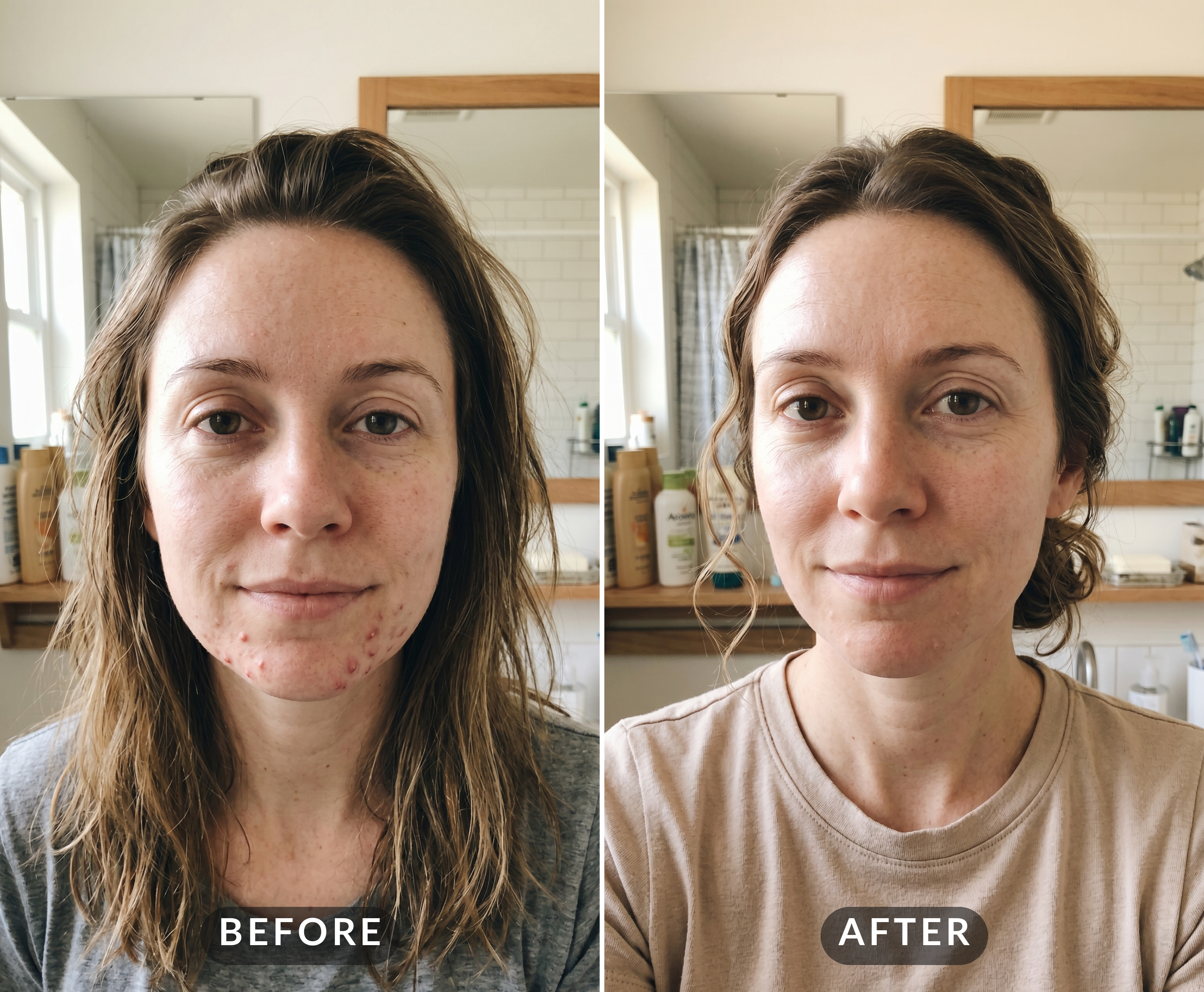 Acne Killer Night Balm